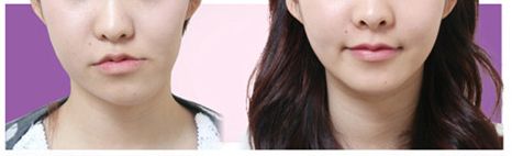 Tìm chỗ phẫu thuật hàm mặt ở khu vực Ansan
