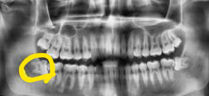 Nhổ răng khôn số 8 ở Hàn có được bảo hiểm không ạ? Ai từng nhổ cho em xin thông tin với 😭